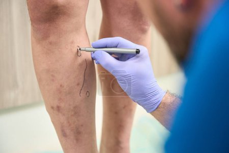 Photo for Close-up photo of men legs in which the doctor circles varicose veins with a marker - Royalty Free Image