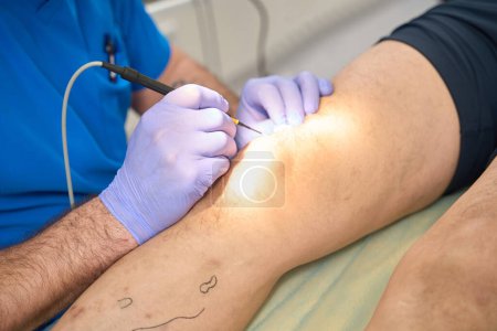 Foto de Foto recortada en sala quirúrgica proceso de intervención quirúrgica utilizando un electrocoagulador en la pierna del paciente - Imagen libre de derechos