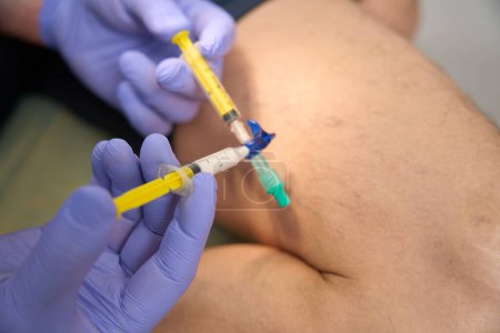 Téléchargez les photos : Deux seringues dans les mains du chirurgien pour le traitement de la maille des veines sur le fond des jambes masculines - en image libre de droit