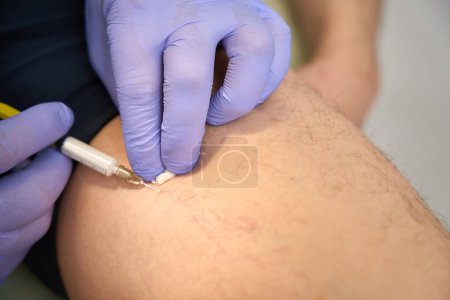 Foto de Inyección con una jeringa para tratar la red de venas en el interior del muslo. Hombre en clínica médica - Imagen libre de derechos