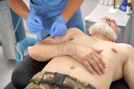 Téléchargez les photos : Physiotherapist conducts acupuncture session on patient with scars on body, doctor wearing protective gloves - en image libre de droit