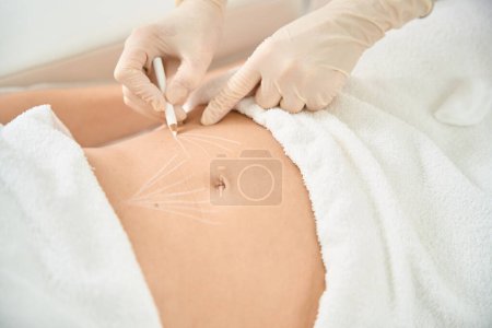 Photo for Dermatocosmetologist in protective gloves making marks with white pencil on the female client body, drawing place for mesothreads inserting, threadlifting procedure in aesthetic medicine clinic - Royalty Free Image