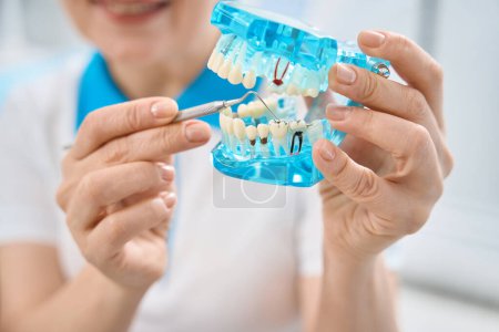 Foto de Técnico dental femenino de primer plano que muestra dientes con caries o caries en el modelo de dientes 3D de plástico, enfermedad progresiva de los dientes y tratamiento rápido para reducir el riesgo de daño permanente - Imagen libre de derechos