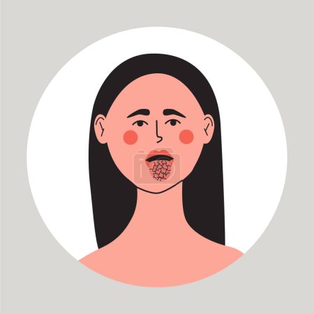 Illustration for Young woman with dry mouth and tongue, xerostomia problem. Flat vector medical illustration. - Royalty Free Image