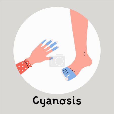 Illustration for Peripheral cyanosis, cyanotic hand and foot. Low oxygen saturation, heart disease, partial obstruction, deep nervous symptom. Flat vector medical illustration. - Royalty Free Image