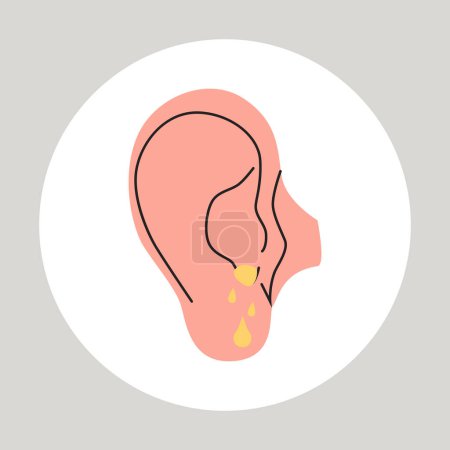 Illustration for Fluid draining from the ear. Otitis, tinnitus symptom. Bacteria in the middle ear. Flat vector medical illustration. - Royalty Free Image
