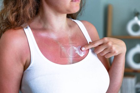 Photo for Young woman applying moisturizer on sunburned skin. Sunburned skin on chest of a woman because of not using cream with sunscreen protection - Royalty Free Image
