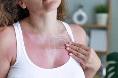 Photo for Woman with sunburn on skin with traces of swimsuit. Sunburned skin on chest of a woman because of not using cream with sunscreen protection - Royalty Free Image