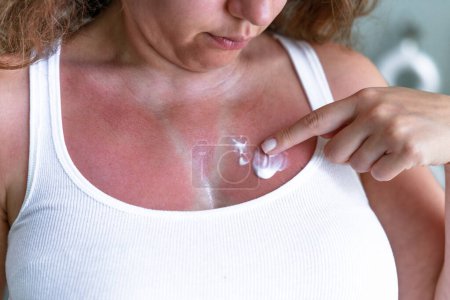 Téléchargez les photos : Jeune femme appliquant un hydratant sur la peau brûlée par le soleil. Peau brûlée par le soleil sur la poitrine d'une femme en raison de ne pas utiliser de crème avec protection solaire - en image libre de droit