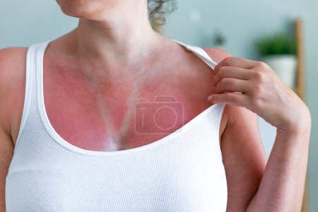 Foto de Mujer con quemaduras solares en la piel con rastros de traje de baño. Piel quemada por el sol en el pecho de una mujer debido a no usar crema con protección solar - Imagen libre de derechos