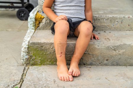 Téléchargez les photos : Un enfant a une égratignure à la jambe. Concentration sélective. Enfant.. - en image libre de droit