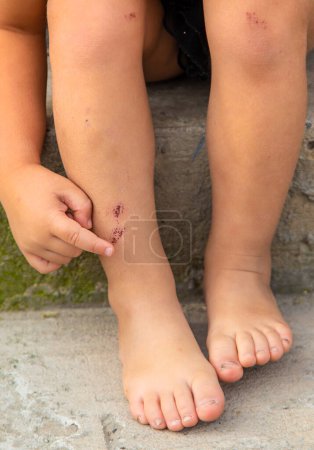 Téléchargez les photos : Un enfant a une égratignure à la jambe. Concentration sélective. Enfant.. - en image libre de droit