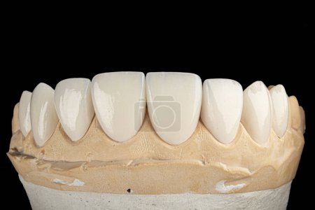 Photo for Emax porcelain veneers on stone model - Royalty Free Image