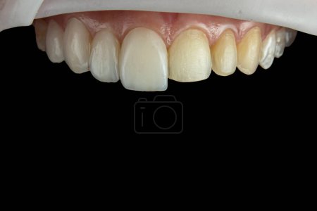 Photo for Intraoral photography of the adaptation trial of porcelain veneer - Royalty Free Image