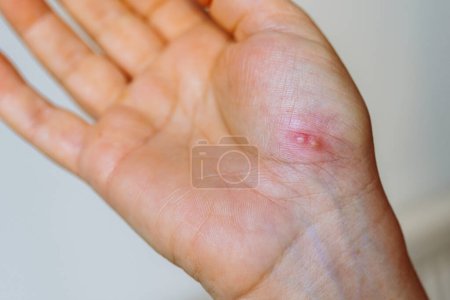 Photo for Womans hand affected by herpes rash. viral disease, skin redness, blisters - Royalty Free Image