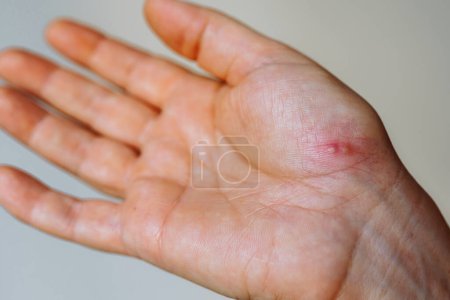 Photo for Womans hand affected by herpes rash. viral disease, skin redness, blisters - Royalty Free Image