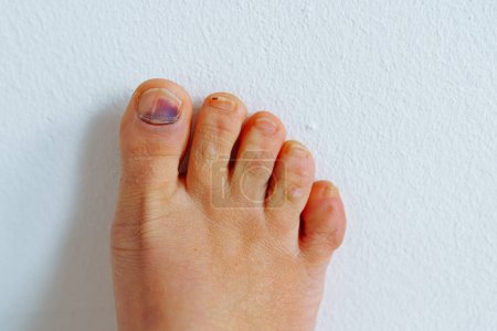 Foto de Pies femeninos descalzos con moretones en la uña del dedo gordo del pie debido a los zapatos incómodos apretados sobre fondo blanco. Hinchazón de los pies en los zapatos. - Imagen libre de derechos