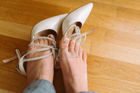 Füße mit Schwellungen und Blutergüssen an den Fußnägeln aufgrund unbequemer Schuhe, High Heels, nach der Arbeit oder beim Gehen, gegen Parkettboden. Blick von oben. Die Füße schwellen in engen Schuhen an. Prellung am Daumennagel. 