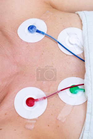 Photo for Holter monitoring equipment on chest of patient, Health care and medical exam, Cardiovascular Examination, Electrocardiography. - Royalty Free Image