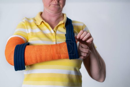 Frau mit gebrochenem rechten Arm, die Gipsabdrücke trägt, um die gebrochenen Knochen an Ort und Stelle zu halten, bis sie heilen, hängend ihren Arm in einem Tragetuch, moderne Behandlungen, qualitativ hochwertiges Foto