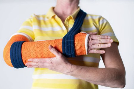 Photo for Woman with a broken right arm wearing plaster casts to hold the broken bones in place until they heal, hanging her arm in a sling, modern treatments, High quality photo - Royalty Free Image