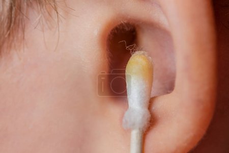 Foto de Cleaning the ear with a cotton swab. The process of cleaning the ears close-up, yellow cotton swab with dirt from the ear. Mother cleaning babys ear, with copy space. - Imagen libre de derechos