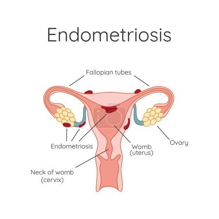 Endometriose. Das Auftreten der Krankheit Endometriose. Endometrium. Infografik