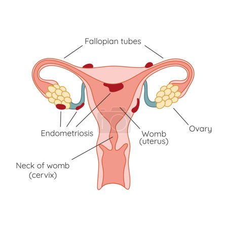 Endometriosis. The appearance of the disease endometriosis. Endometrium. Infographic