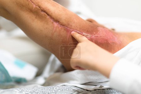 Téléchargez les photos : Burned area on the leg following radiotherapy, surgery to remove the cancerous tumor - en image libre de droit