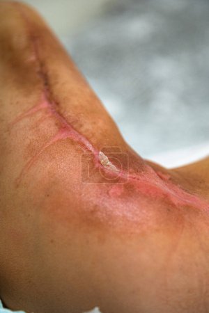 Foto de Burned area on the leg following radiotherapy, surgery to remove the cancerous tumor - Imagen libre de derechos