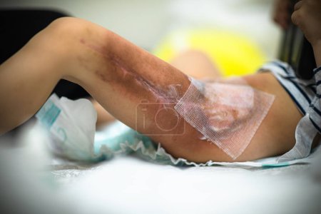 Área quemada en la pierna después de la radioterapia, cirugía para extirpar el tumor canceroso