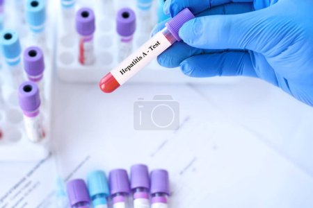 The doctor holds a test blood sample tube positive with hepatitis A virus (HAV) test on the background of medical test tubes