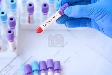 Médico sosteniendo un tubo de muestra de sangre de prueba con prueba de prolactina en el fondo de los tubos de prueba médica con análisis.