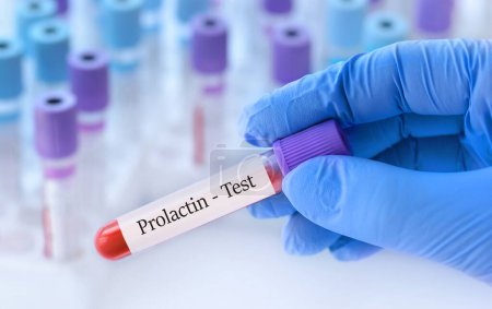 Arzt im Reagenzglas mit Prolaktin-Test auf dem Hintergrund medizinischer Reagenzgläser mit Analysen.