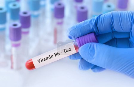 Téléchargez les photos : Docteur tenant un tube d'échantillon de sang d'essai avec le test de vitamine B6 sur le fond des tubes d'essai médicaux avec des analyses.Bannière. - en image libre de droit