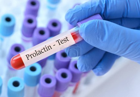Arzt im Reagenzglas mit Prolaktin-Test auf dem Hintergrund medizinischer Reagenzgläser mit Analysen.