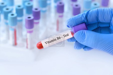 Photo for Doctor holding a test blood sample tube with Vitamin B6 test on the background of medical test tubes with analyzes.Banner. - Royalty Free Image