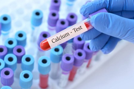 Photo for Doctor holding a test blood sample tube with calcium test on the background of medical test tubes with analyzes - Royalty Free Image