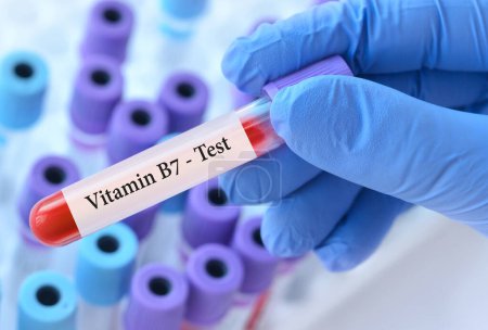 Téléchargez les photos : Médecin tenant un tube à échantillon de sang d'essai avec test de vitamine B7 sur le fond des tubes à essai médicaux avec analyses - en image libre de droit