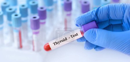Photo for Doctor holding a test blood sample tube with Thyroid test on the background of medical test tubes with analyzes - Royalty Free Image