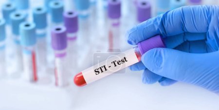 Foto de Médico sosteniendo un tubo de muestra de sangre de prueba con STI (infección de transmisión sexual) prueba en el fondo de los tubos de prueba médica con análisis - Imagen libre de derechos
