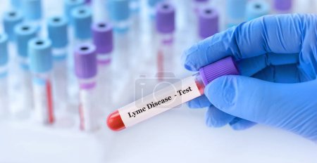 Foto de Médico sosteniendo un tubo de muestra de sangre de prueba con la prueba de la enfermedad de Lyme en el fondo de los tubos de prueba médica con análisis - Imagen libre de derechos