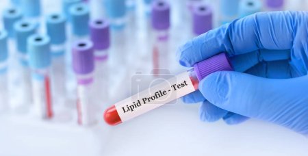 Photo for Doctor holding a test blood sample tube with Lipid Profile test on the background of medical test tubes with analyzes - Royalty Free Image