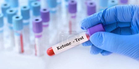 Photo for Doctor holding a test blood sample tube with ketone test on the background of medical test tubes with analyzes - Royalty Free Image