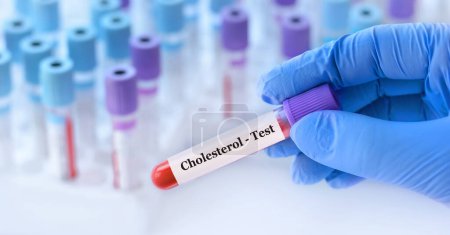 Foto de Médico sosteniendo un tubo de muestra de sangre de prueba con prueba de colesterol en el fondo de los tubos de prueba médica con análisis - Imagen libre de derechos