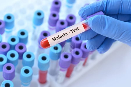 Téléchargez les photos : Médecin tenant une éprouvette de sang avec test Malaria Ag (Pf, Pv) sur le fond des éprouvettes médicales avec analyses - en image libre de droit