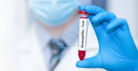 Médecin tenant une éprouvette sanguine avec test d'hémophilie sur le fond des éprouvettes médicales avec analyses.