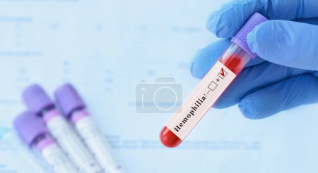 Foto de Médico sosteniendo un tubo de muestra de sangre de prueba con prueba de hemofilia positiva en el fondo de los tubos de prueba médica con análisis. - Imagen libre de derechos