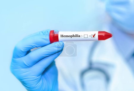 Médico sosteniendo un tubo de muestra de sangre de prueba con prueba de hemofilia positiva en el fondo de los tubos de prueba médica con análisis.