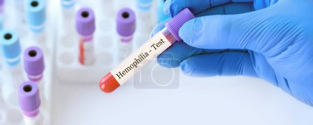Médico sosteniendo un tubo de muestra de sangre de prueba con prueba de hemofilia en el fondo de los tubos de prueba médica con análisis.